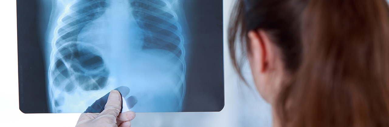 Cáncer de pulmón: no te descuides