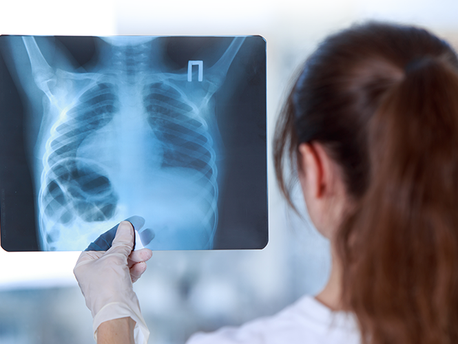 Cáncer de pulmón: no te descuides