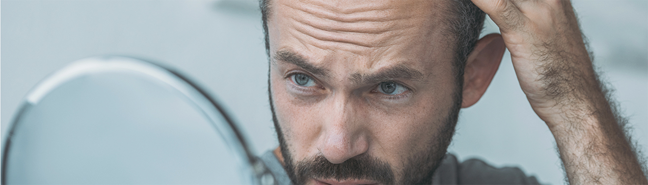Alopecia: Un problema común