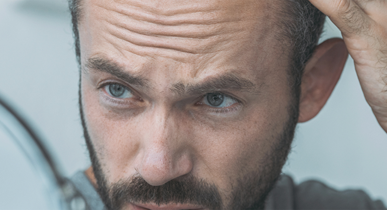 Alopecia: Un problema común