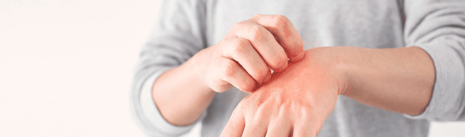 Urticaria por calor: síntomas y cómo prevenirla