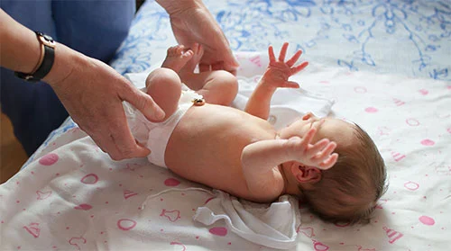 Hernia Umbilical: complicaciones y cómo tratarla