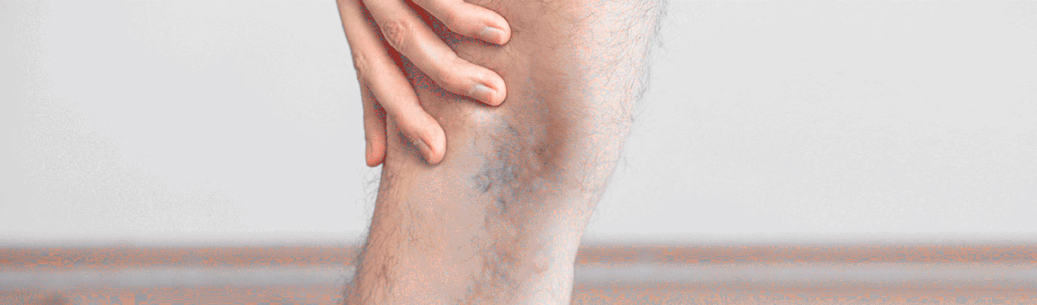 Varices en hombres: causas y prevención