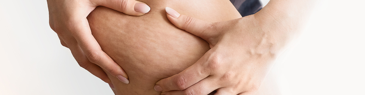 ¿Cómo prevenir y tratar la celulitis?
