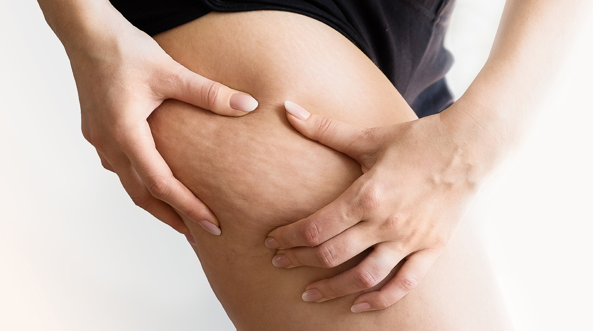 ¿Cómo prevenir y tratar la celulitis?