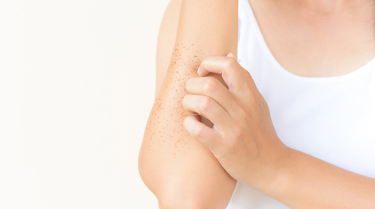 Queratosis Pilaris: Pequeños granos la piel, ¿a qué se debe?