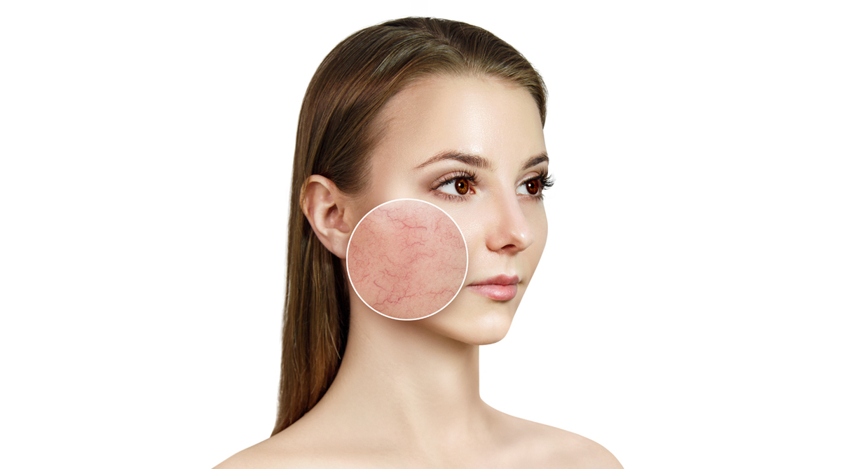 ¿Cómo controlar la rosacea?